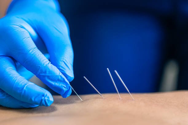 Dry Needling Islamabad - OKCURES