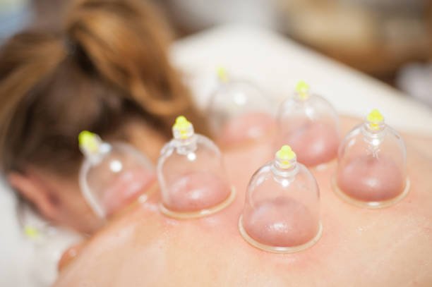 Hijama Cupping Islamabad - OKCURES